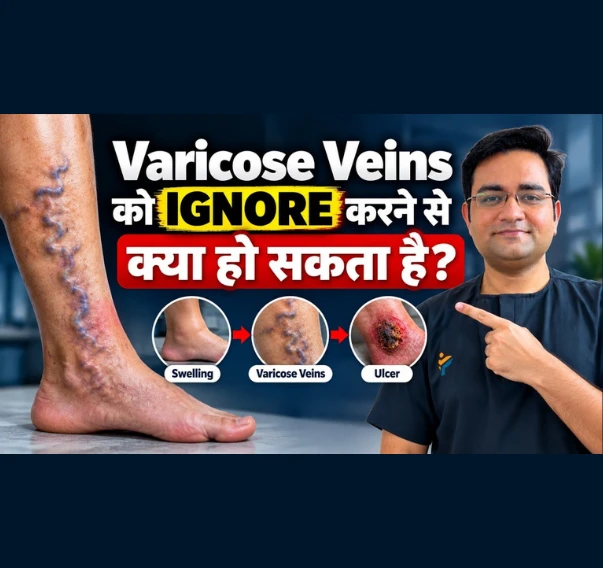 Varicose Veins 3